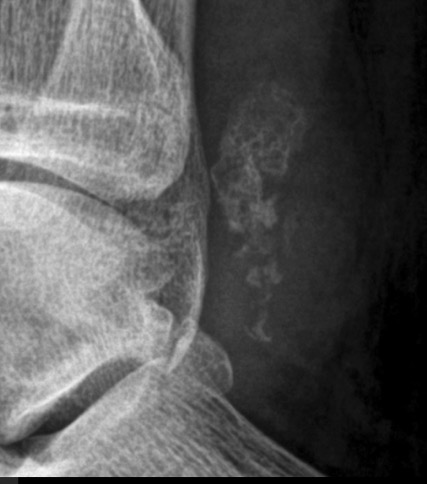 Figure 2 for case Chondroma ( RID4126 )